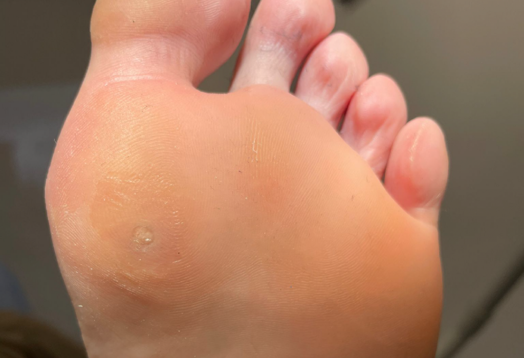 Callosidad en pie atendida en la Clínica Podológica Manel Rodríguez en Santa María de Palautordera