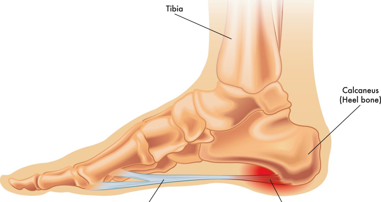 Diagrama anatómico de fascitis plantar mostrando tibia, calcáneo y fascia plantar en la Clínica Podológica Manel Rodríguez