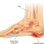Diagrama anatómico de fascitis plantar mostrando tibia, calcáneo y fascia plantar en la Clínica Podológica Manel Rodríguez