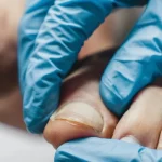 Tratamiento de uña encarnada en Clínica Podológica Manuel Rodriguez, Santa María de Palautordera