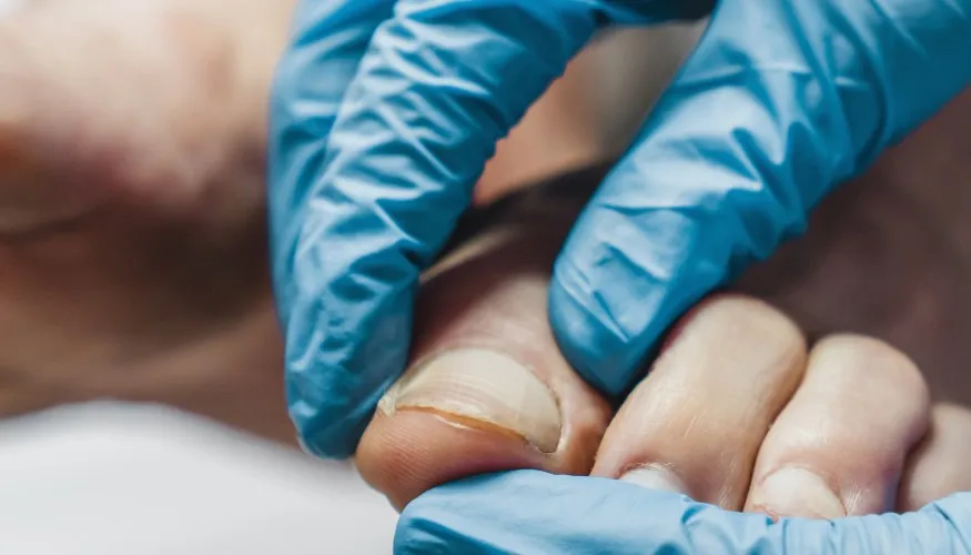 Tratamiento de uña encarnada en Clínica Podológica Manuel Rodriguez, Santa María de Palautordera